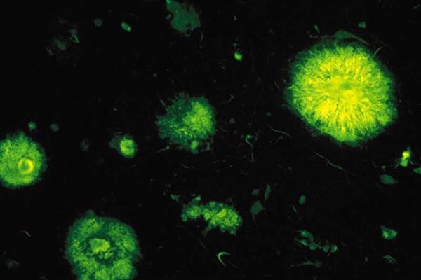 Plaques séniles, ou plaques amyloïdes, observées en fluorescence dans un cas de maladie d’Alzheimer. Elles proviennent d’une accumulation du peptide ß-amyloïde, formé de 42 acides aminés. © Inserm/U837 